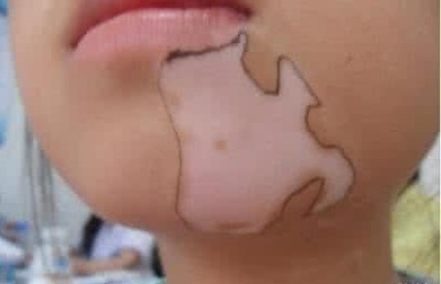 临床上脸部白癜风的诊断的方式有哪些