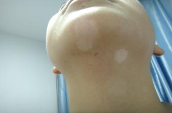 脖子上出现白斑是为什么