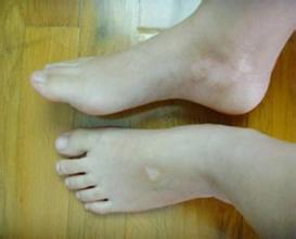 白癜风预防四要素具体是什么